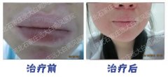 308光照治疗白癜风多长时间能好
