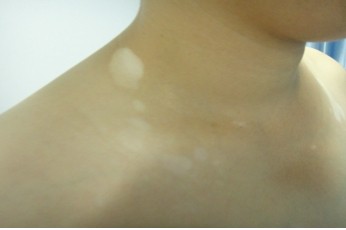 脖子上有一块白斑是白癜风吗