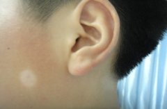 白癜风都有哪些比较好的治疗方法