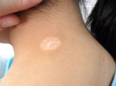 白癜风治疗能用偏方吗