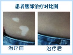 白癜风在治疗的时候注意什么