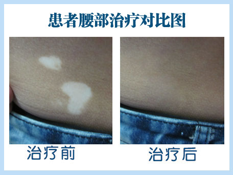 白癜风在治疗的时候注意什么