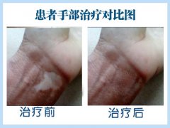 外伤引发的白癜风会不会遗传给孩子