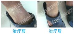早期的白癜风去正规大医院治疗要多少钱呢