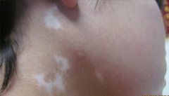 白癜风间隔一段时间治疗好不