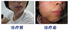 宝宝得了白癜风用什么方法治疗好
