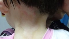 儿童脖子白癜风如何治疗