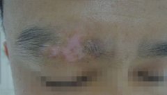患者要怎样配合医生治疗白癜风