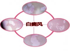 女性长白癜风对患者的身体有什么伤害
