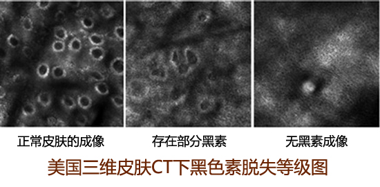 白癜风检查区分