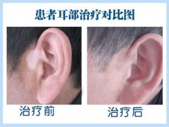 白癜风在治疗期间应该要注意哪些问题呢