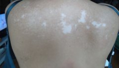 治疗背部白癜风不要随意用药