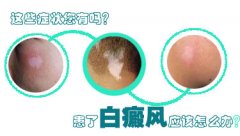 白癜风治疗可以使用性激素吗
