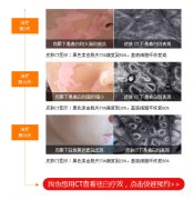 受伤部位白癜风斑点怎么治疗呢