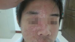 他们说熬夜也会导致白癜风是不是真的