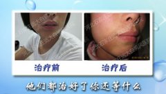 眼部周围怎么检查是否是白癜风病呢