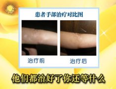 白癜风长了可能不扩散吗
