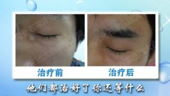 治疗白癜风要坚持哪些原则
