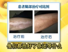 怎样才能更好地治疗白癜风