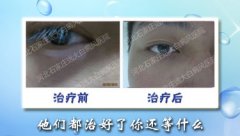 如何辅助背部白癜风的治疗