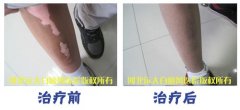 腿上有白癜风，怎么做能治好