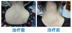 夏季白癜风患者能不能吃黄瓜