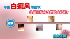 胸前白癜风抹什么药能治