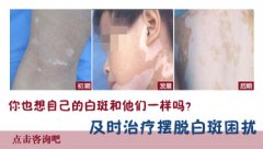 男性泛发型白癜风的表现是什么