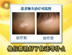 想要治好稳定期白癜风衡水白癜风医院行不行