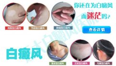 泛发型白癜风的症状是什么样