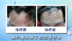 孩子白癜风治疗需要怎么护理