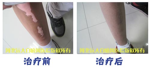 腿上长了几块白斑怎么治康复快