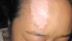 女性要怎么治疗白癜风才能保证健康