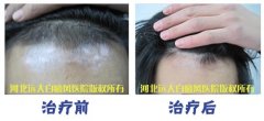 头部的白斑该如何医治