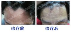 夏季白癜风治疗的四大误区是什么
