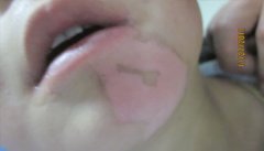 如何正确判断孩子脸上的白斑是不是白癜风