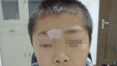 儿童白癜风用308激光治疗几次能有效果