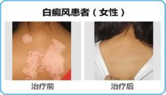 背部白癜风扩散了该怎么办