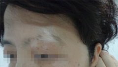 脸上出现白癜风的白斑怎么办