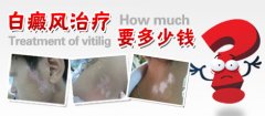 青少年泛发型白癜风治疗能做什么手术