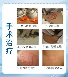 腹部白癜风