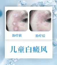 白斑病白癜风康复病例