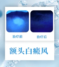 白斑病白癜风康复病例