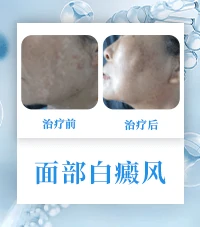 白斑病白癜风康复病例