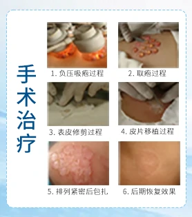 散发型白癜风