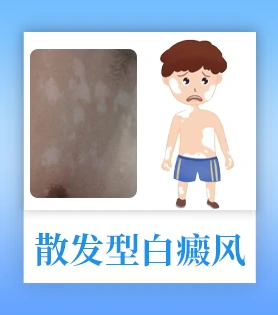 散发型白癜风