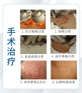 腿部白癜风